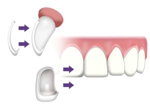 VENEERS