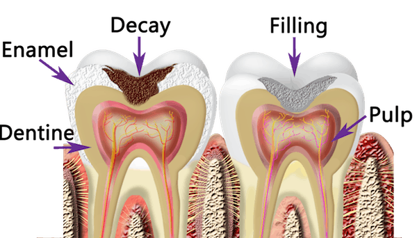 Benefits of Composite Bonding or White Filling - London Specialist