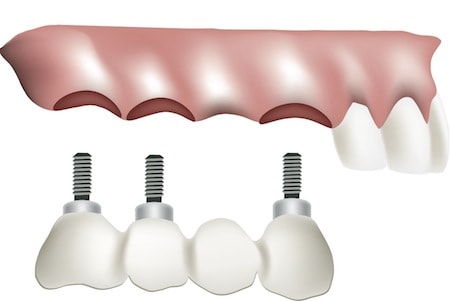 teeth replacement