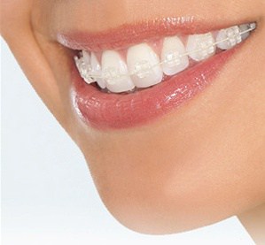 clear-braces1