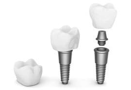 dental-implants