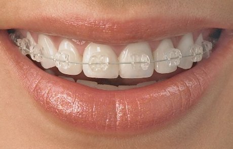 teeth straightening in london - fixed braces