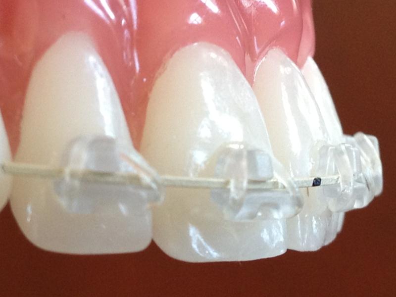 Clear braces (1)