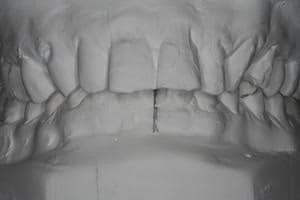 Dental Veneer Treatment before