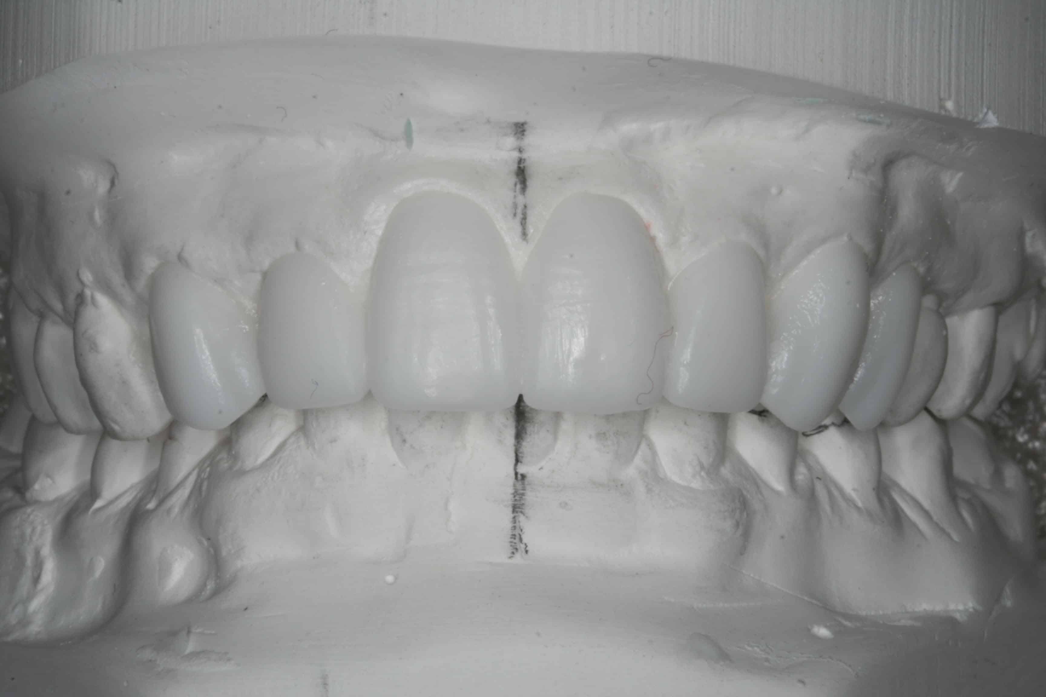 dental veneers West London Wax up model