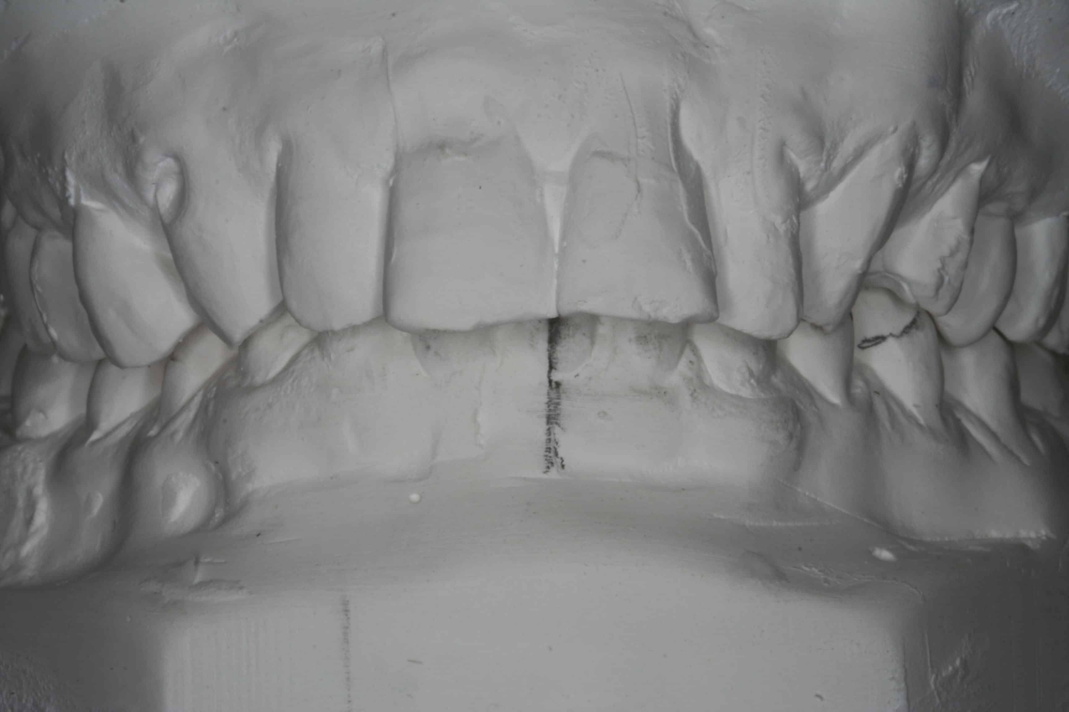pre-op dental veneers treatment