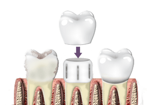 crowns Dental Crowns Image