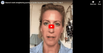 Eleanor’s teeth straightening journey at Garden Square Dental Practice Image