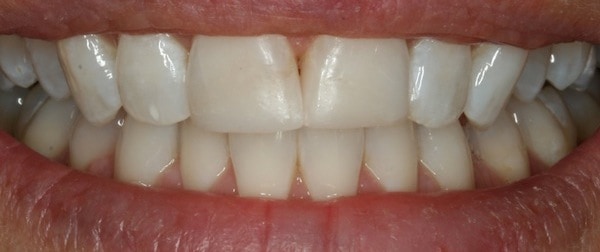 After Whitening 1
