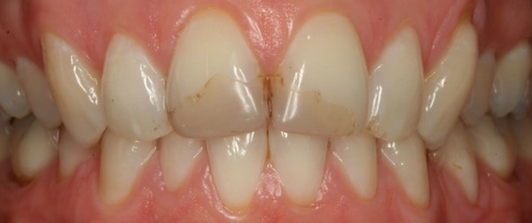 Before Whitening 1