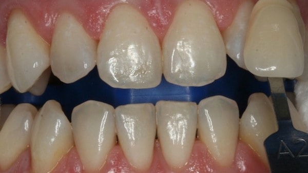 Before Whitening 2