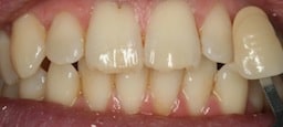 Before Whitening 3