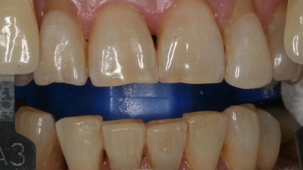 Before Whitening 4