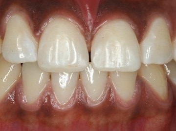 Closed with Composite Bonding 2