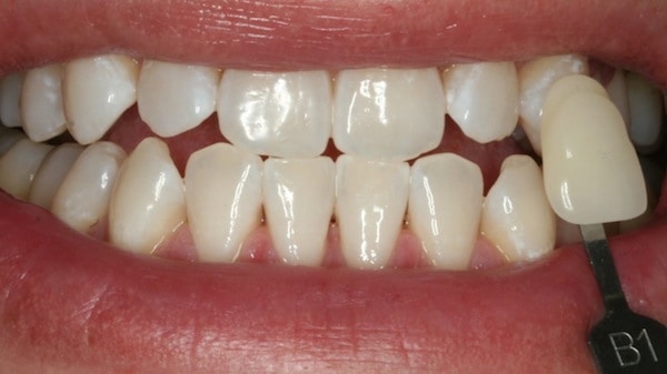 Immediately after Zoom Whitening 2