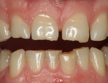 Tooth Wear on front teeth 2