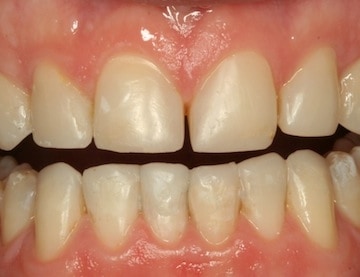 Treated with Composite Bonding 1