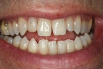Uneven size teeth