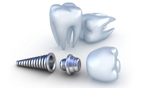 dental implants image