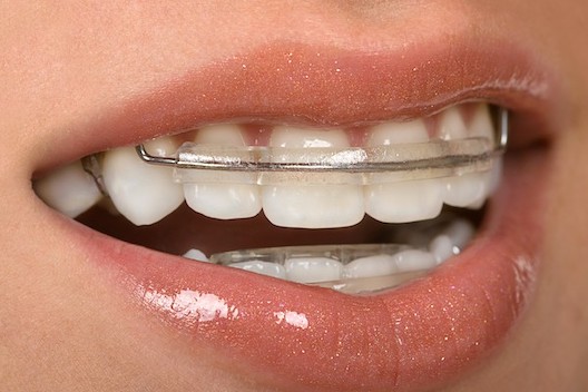 Orthodontics West London Image