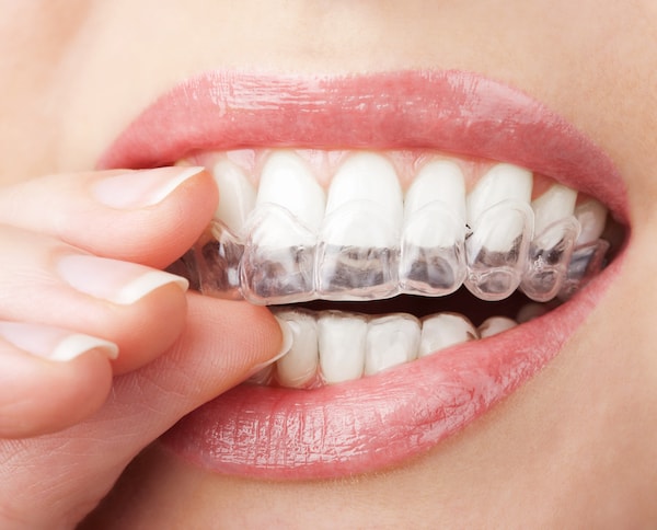 SmileTru Clear Aligners Image