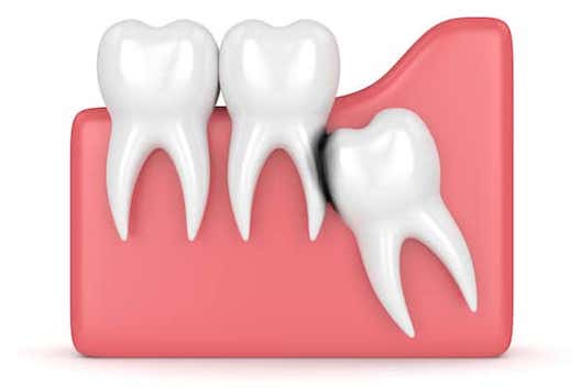 Tooth Erosion Image Tooth Erosion Image