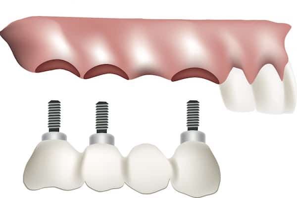 Tooth Replacement West London Image