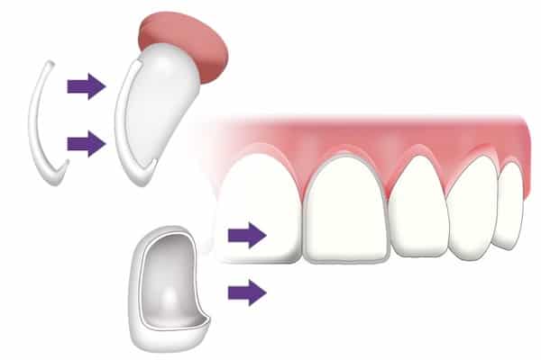 Veneers West London image