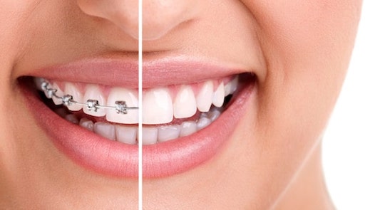 teeth straightening west london image