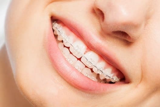 Fast Braces Image