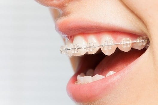 Orthodontic Treatments CFast cosmetic braces Image