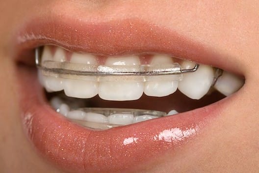 Orthodontics-Inamn Aligner-Image