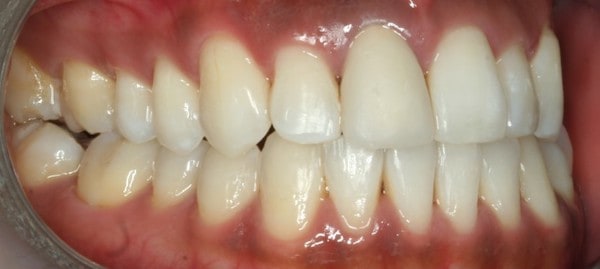 fast braces after