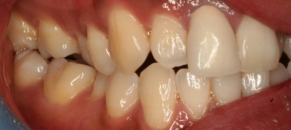 fast braces before