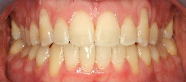 fastbraces 4 after treatment