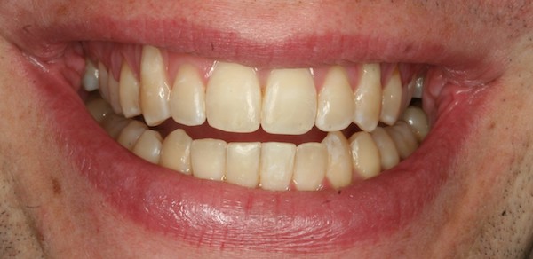 fastbraces 5 after treatment