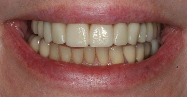 lower veneers before