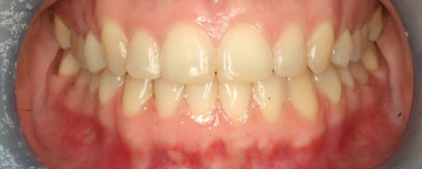 orthodontics fastbraces after treatment