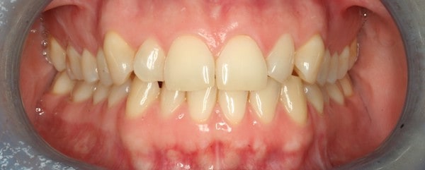 orthodontics fastbraces before treatment