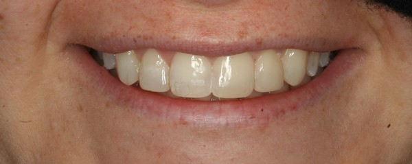 smiletru aligners 2 after treatment
