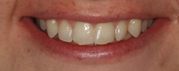 smiletru aligners 2 treatment