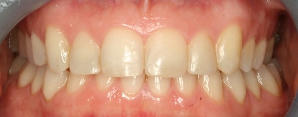 smiletru aligners after treatment