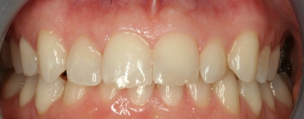 smiletru aligners before treatment