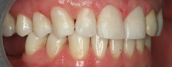 teeth whitening after treatment