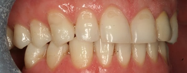 teeth whitening before treatment