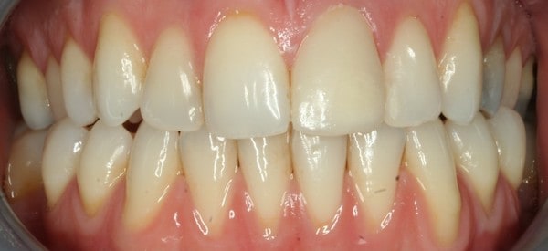 whitening after treatment