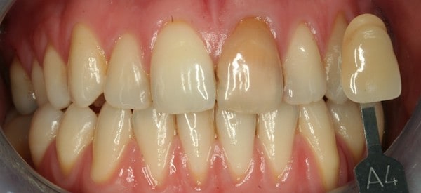 whitening before treatment