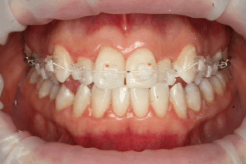 Orthodontic case study 1 Image 2
