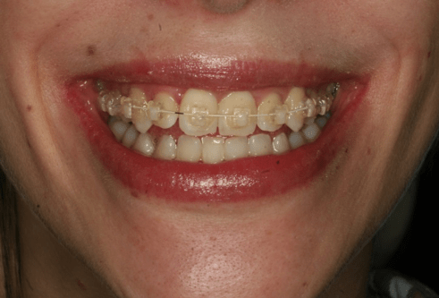 Orthodontic case study 1 Image 2