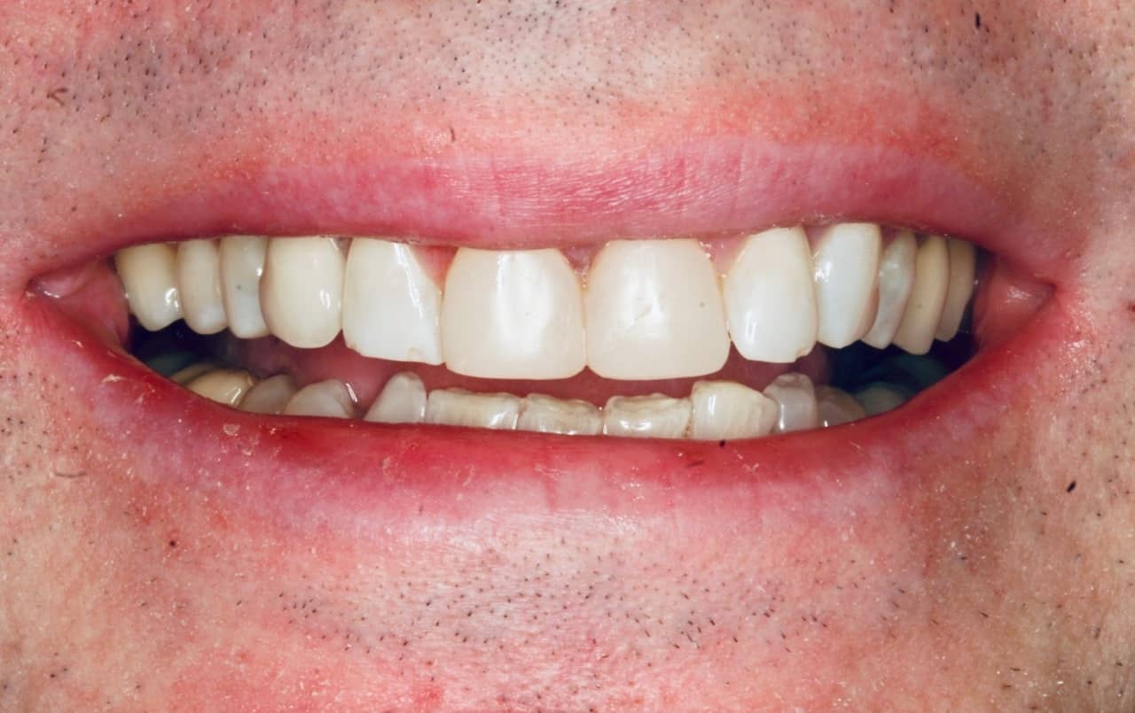 composite bonding over the outside surface and edges of the front teeth